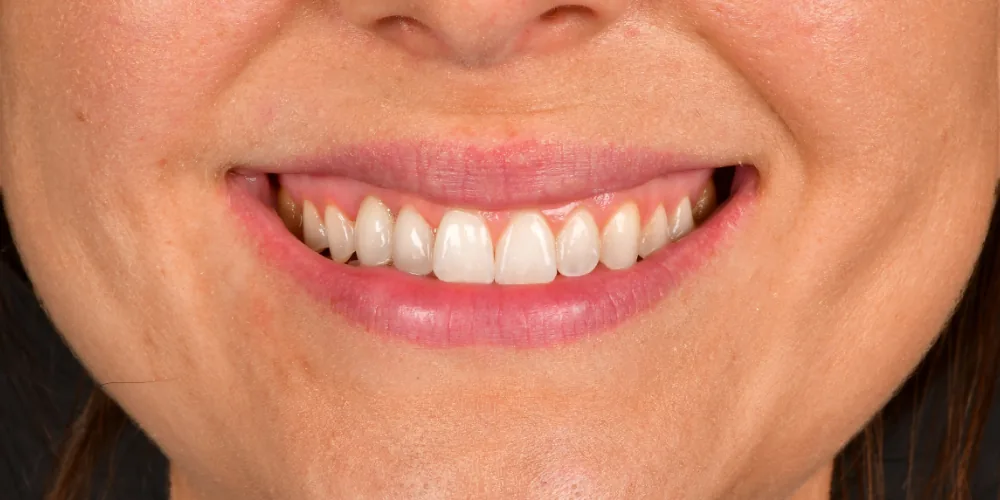 Before & After Gallery: Front Implants After 2 of 4