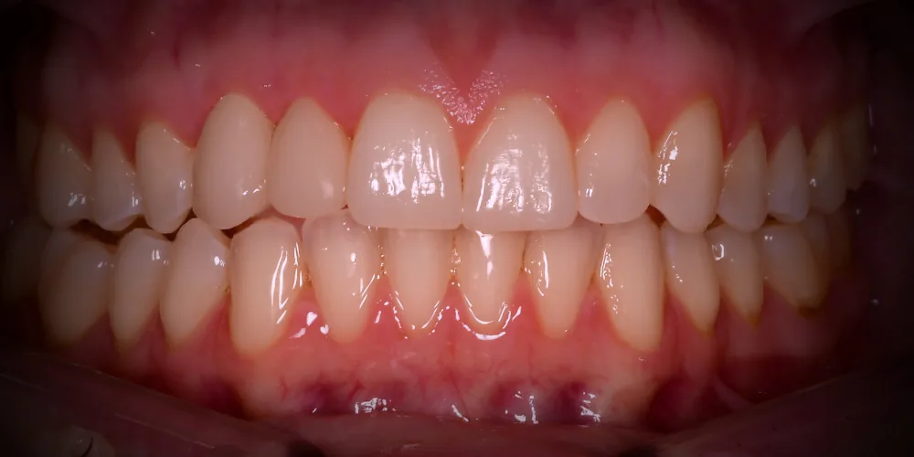 Before & After Gallery: Front Implants After 4 of 4
