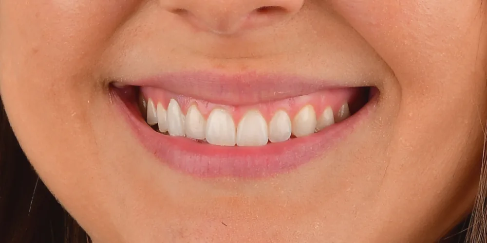 Before & After Gallery: Front Implants Before 1 of 4