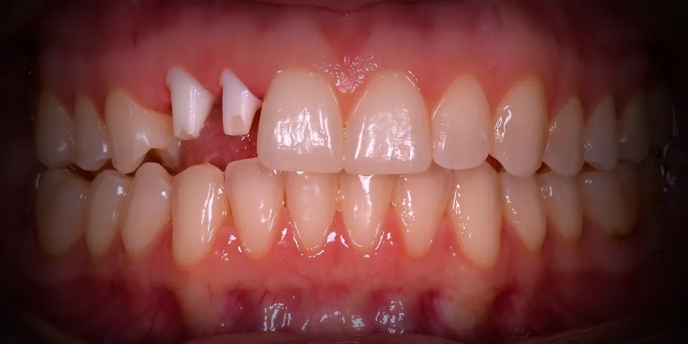 Before & After Gallery: Front Implants Before 3 of 4