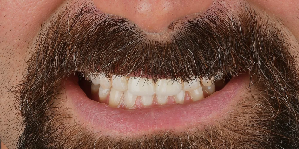 Before & After Gallery: Front Tooth Crown and Implant After 2 of 4