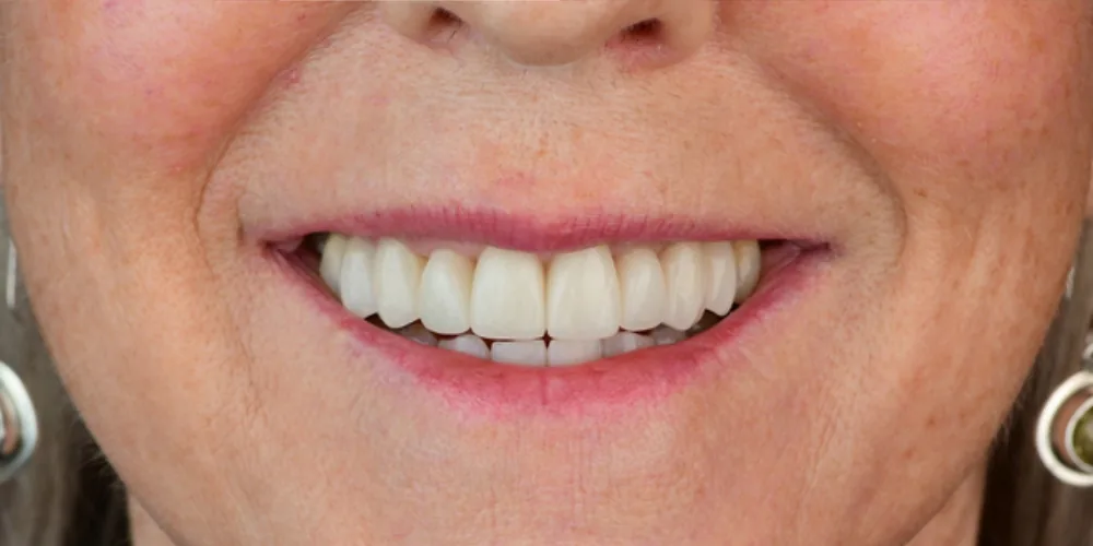 Before & After Gallery: Front Tooth Crown and Implant After 2 of 4