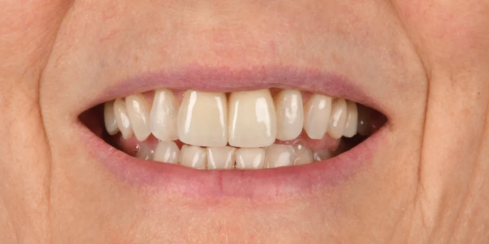 Before & After Gallery: Front Tooth Crown and Implant After 2 of 4