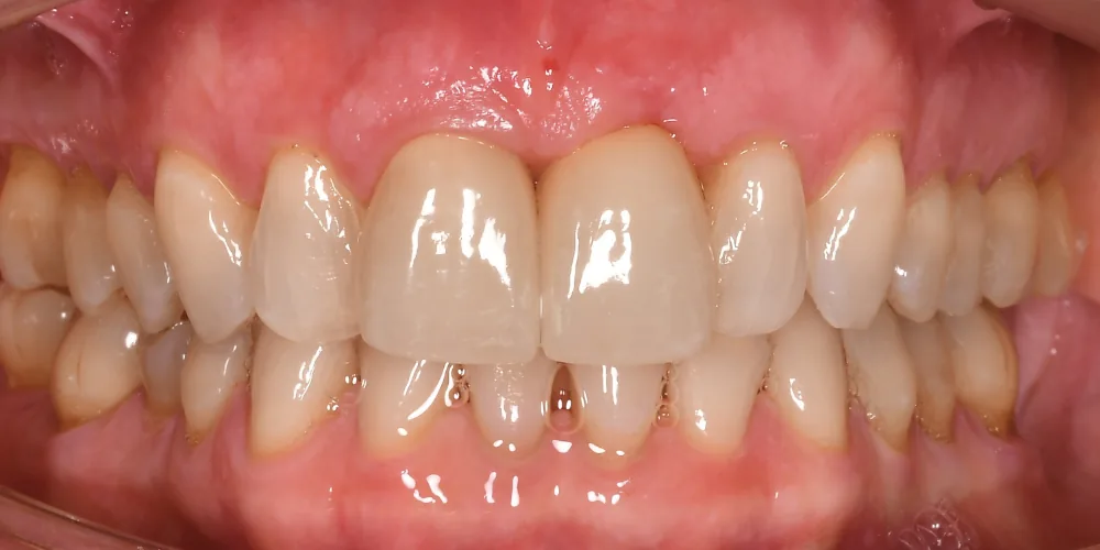 Before & After Gallery: Front Tooth Crown and Implant After 4 of 4