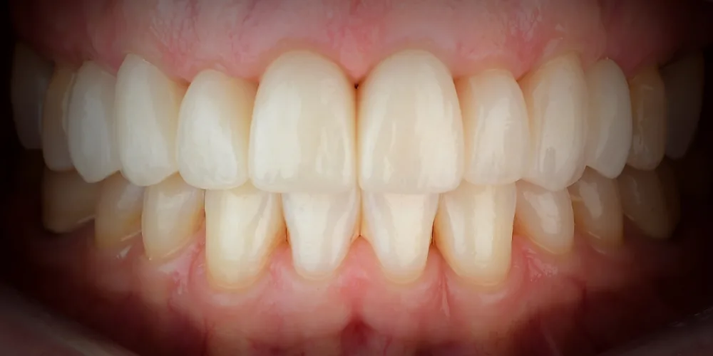 Before & After Gallery: Front Tooth Crown and Implant After 4 of 4