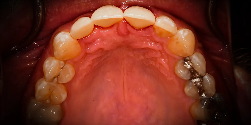 Before & After Gallery: Front Tooth Crown and Implant After 4 of 4