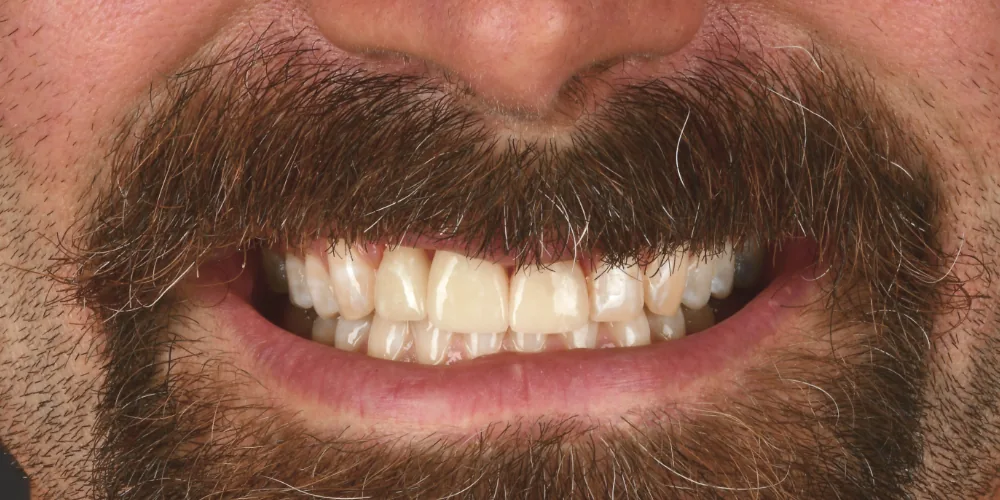 Before & After Gallery: Front Tooth Crown and Implant Before 1 of 4