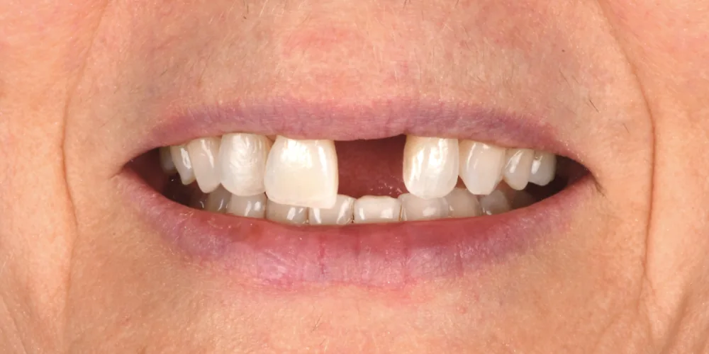 Before & After Gallery: Front Tooth Crown and Implant Before 1 of 4