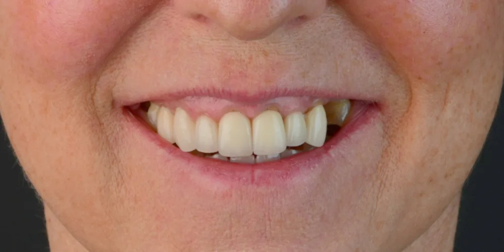 Before & After Gallery: Front Tooth Crown and Implant Before 1 of 4