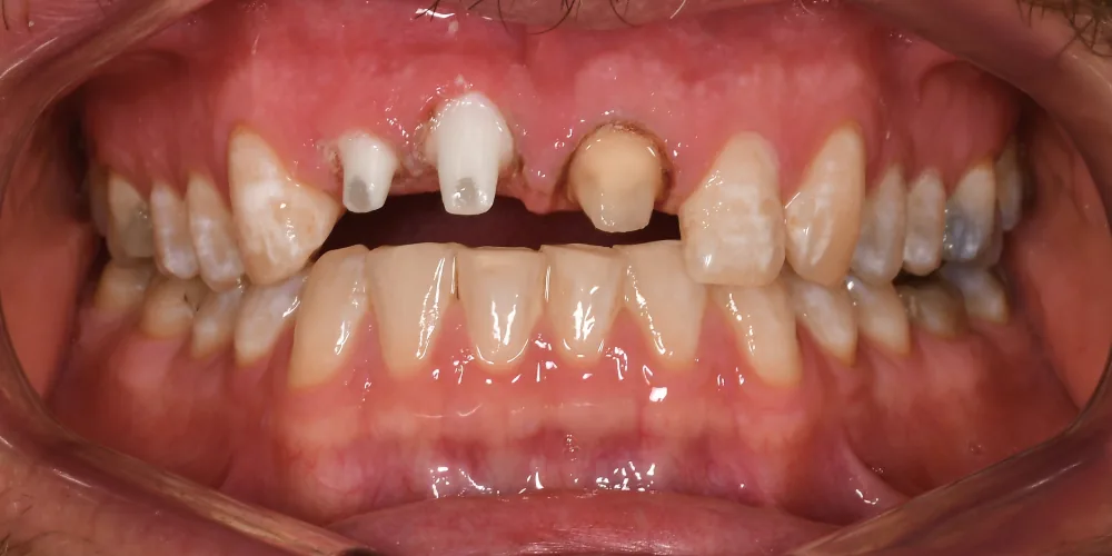Before & After Gallery: Front Tooth Crown and Implant Before 3 of 4