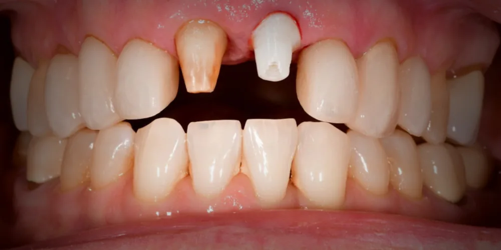 Before & After Gallery: Front Tooth Crown and Implant Before 3 of 4