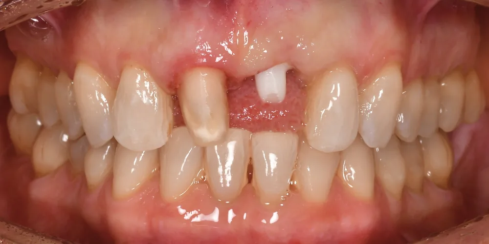 Before & After Gallery: Front Tooth Crown and Implant Before 3 of 4