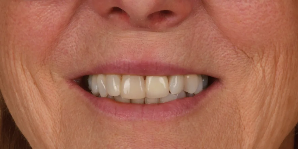 Before & After Gallery: Front Tooth Crowns