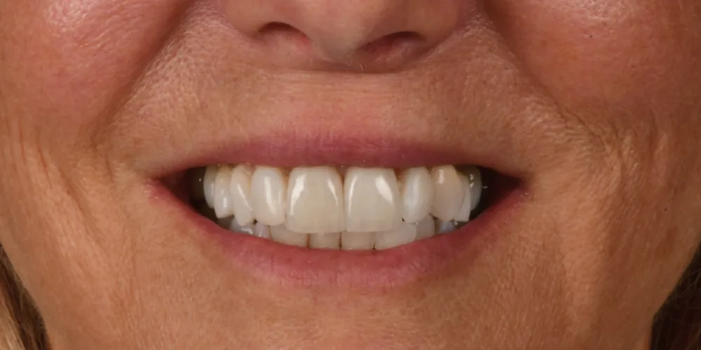 Before & After Gallery: Front Tooth Crowns After 2 of 4