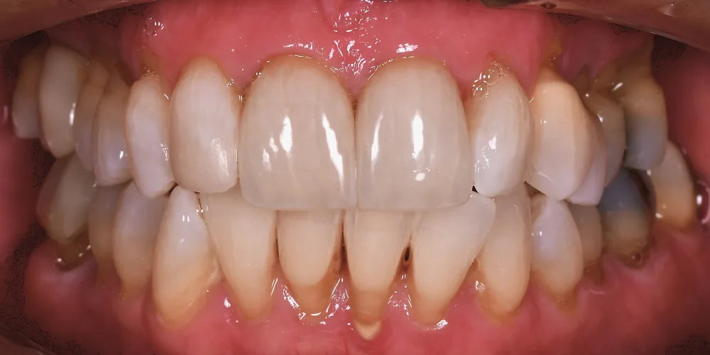 Before & After Gallery: Front Tooth Crowns After 4 of 4