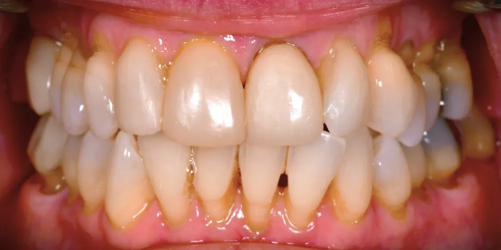Before & After Gallery: Front Tooth Crowns Before 3 of 4