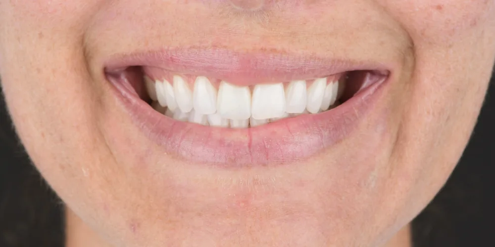 Before & After Gallery: Front Tooth Implant After 2 of 4
