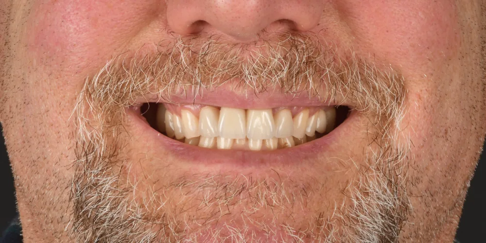 Before & After Gallery: Front Tooth Implant After 2 of 4