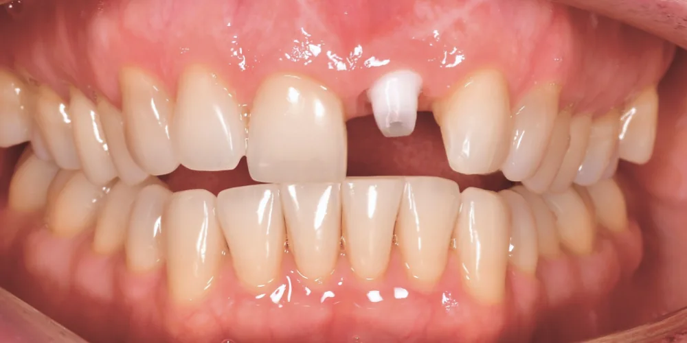 Before & After Gallery: Front Tooth Implant After 2 of 4