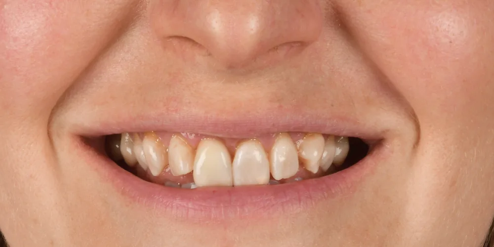 Before & After Gallery: Front Tooth Implant After 2 of 4