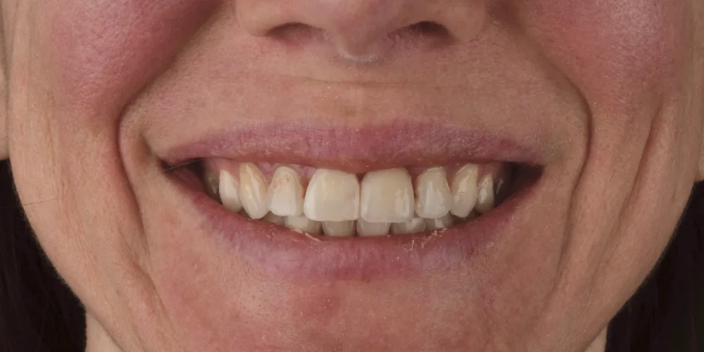 Before & After Gallery: Front Tooth Implant After 2 of 4