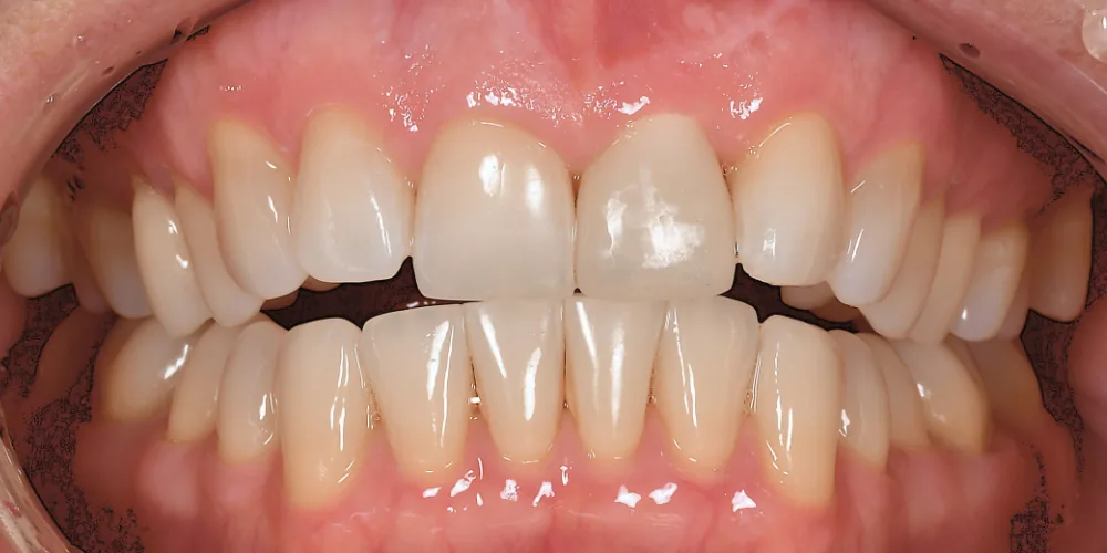 Before & After Gallery: Front Tooth Implant After 4 of 4