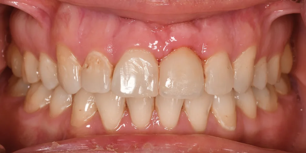 Before & After Gallery: Front Tooth Implant After 4 of 4