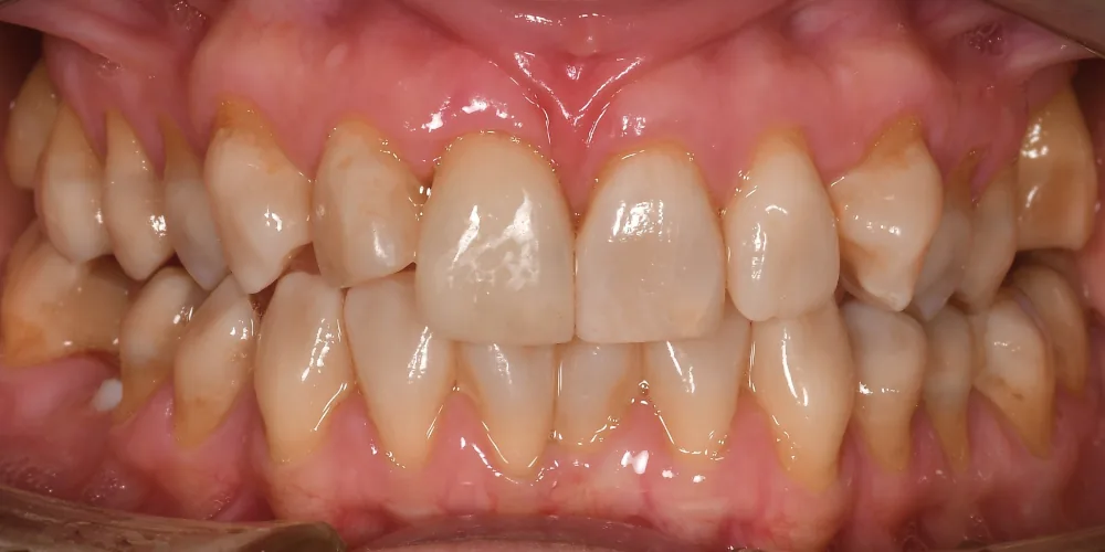 Before & After Gallery: Front Tooth Implant After 4 of 4