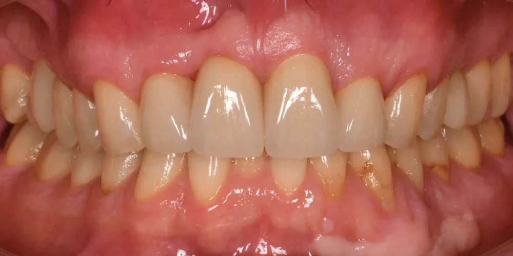 Before & After Gallery: Front Tooth Implant After 4 of 4
