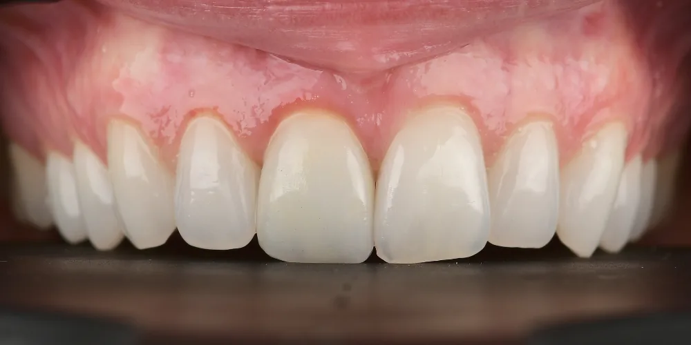 Before & After Gallery: Front Tooth Implant After 4 of 4