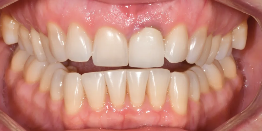 Before & After Gallery: Front Tooth Implant Before 1 of 4