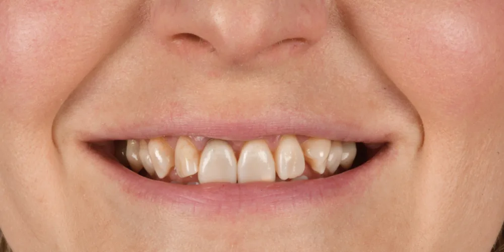 Before & After Gallery: Front Tooth Implant Before 1 of 4