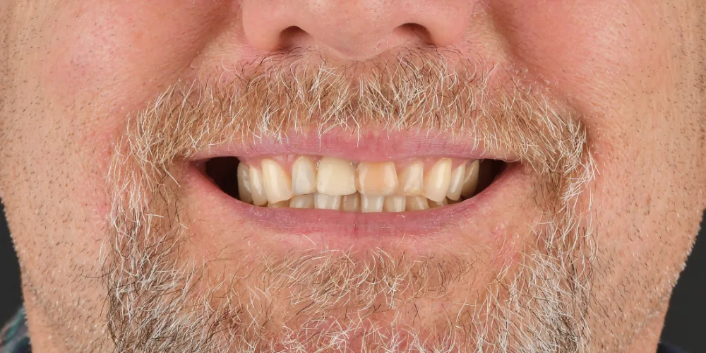 Before & After Gallery: Front Tooth Implant Before 1 of 4