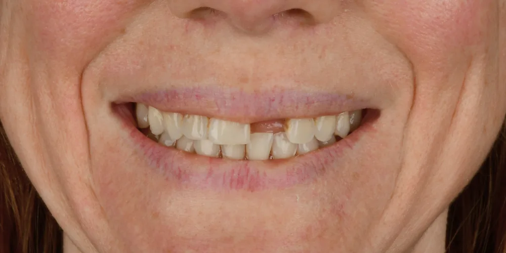 Before & After Gallery: Front Tooth Implant Before 1 of 4