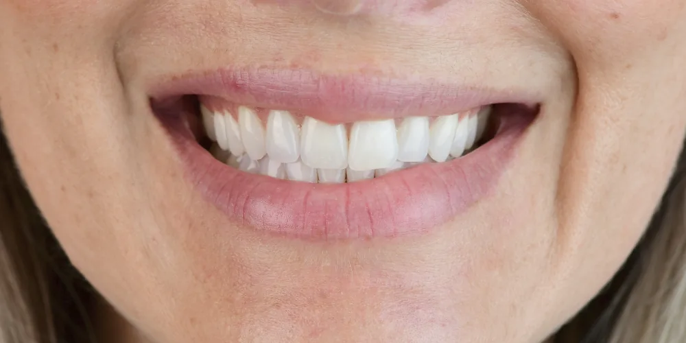 Before & After Gallery: Front Tooth Implant Before 1 of 4