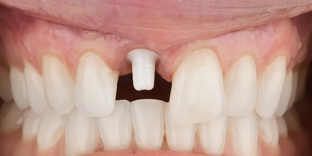 Before & After Gallery: Front Tooth Implant Before 3 of 4