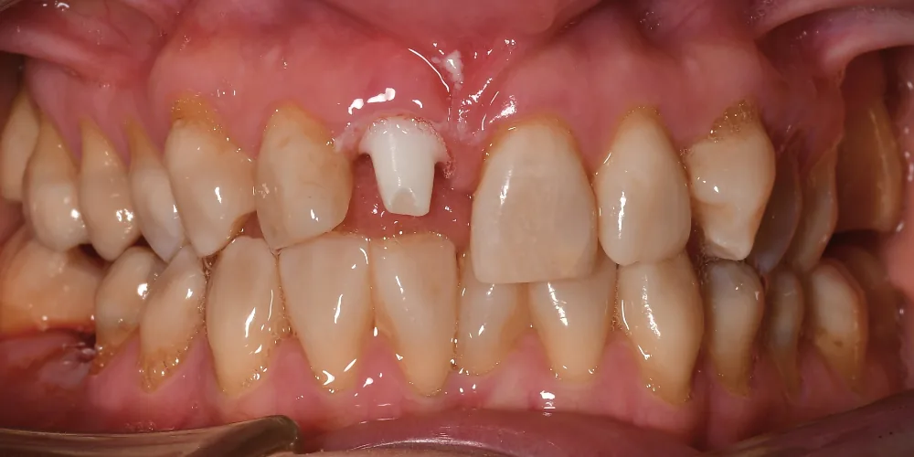 Before & After Gallery: Front Tooth Implant Before 3 of 4