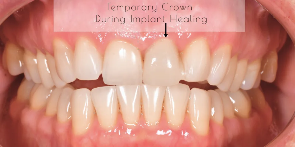 Before & After Gallery: Front Tooth Implant Before 3 of 4