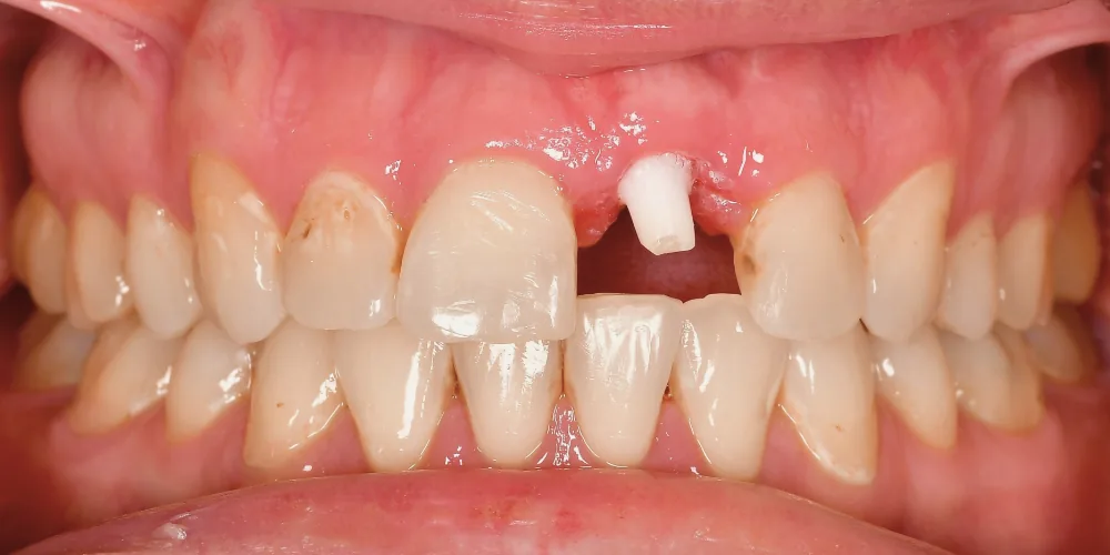 Before & After Gallery: Front Tooth Implant Before 3 of 4