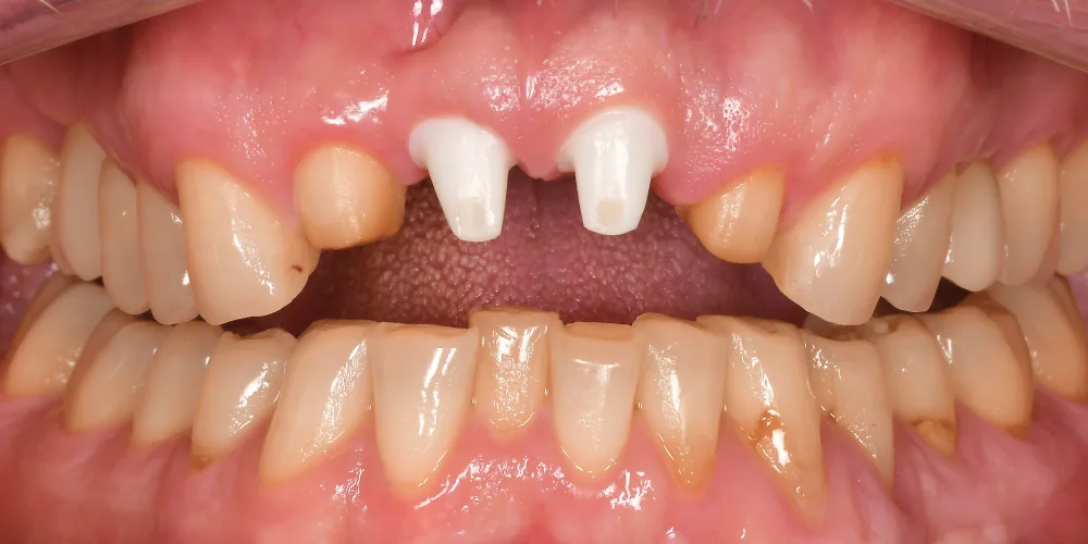 Before & After Gallery: Front Tooth Implant Before 3 of 4