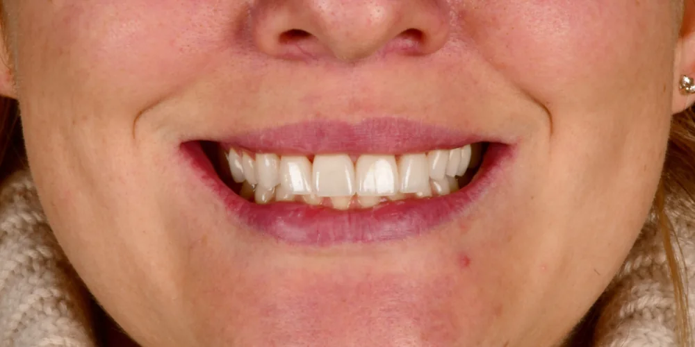 Before & After Gallery: Front Tooth Implant, Veneers After 2 of 4