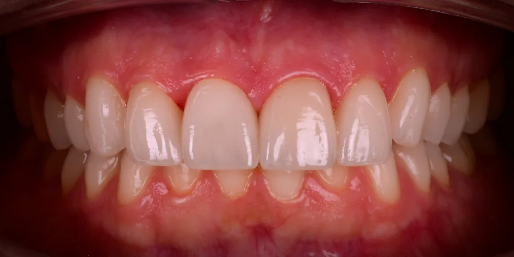 Before & After Gallery: Front Tooth Implant, Veneers After 4 of 4