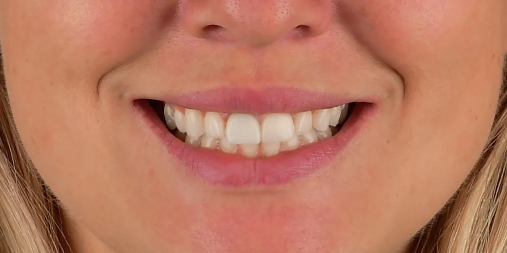 Before & After Gallery: Front Tooth Implant, Veneers Before 1 of 4