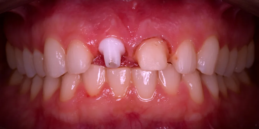 Before & After Gallery: Front Tooth Implant, Veneers Before 3 of 4