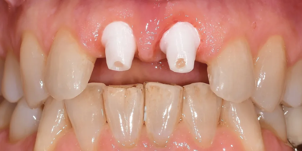 Before & After Gallery: Front Tooth Implants After 2 of 4
