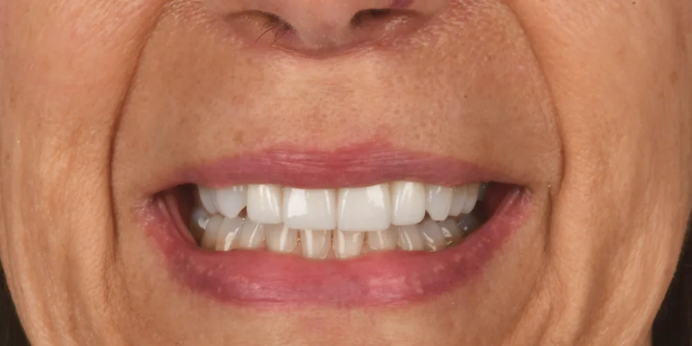 Before & After Gallery: Front Tooth Implants After 2 of 4