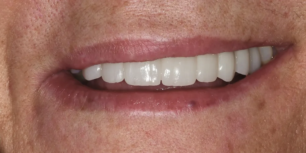 Before & After Gallery: Front Tooth Implants After 2 of 4