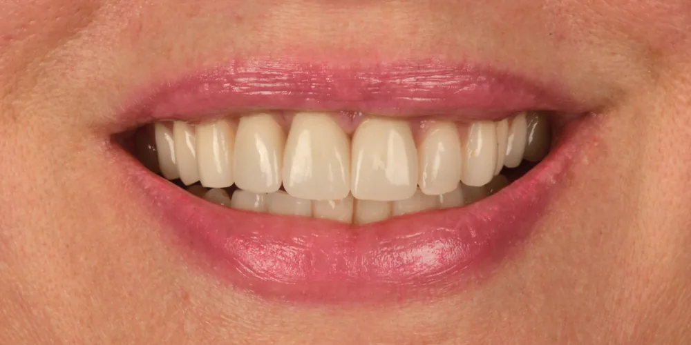Before & After Gallery: Front Tooth Implants After 2 of 4