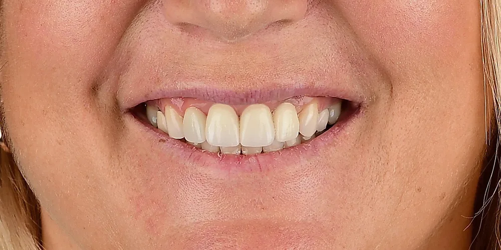 Before & After Gallery: Front Tooth Implants After 2 of 4