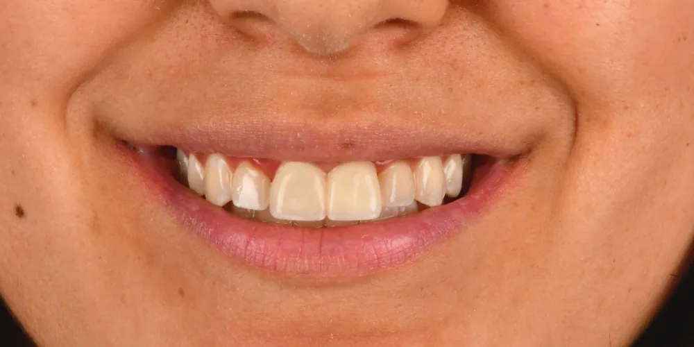Before & After Gallery: Front Tooth Implants After 2 of 4